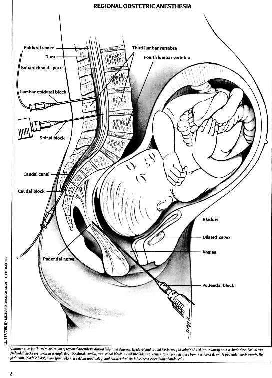 epidural.jpg